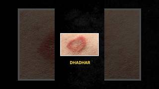 Ringworm fungal infection treatment podocast [upl. by Nairim]