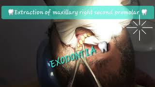 Buccal to lingual motion maxillary 2nd premolar extraction with double curvatures Sshaped roots [upl. by Cassella427]