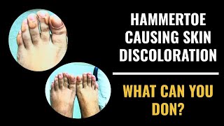 Hammertoe causing skin discoloration  What you can do [upl. by Suirradal]