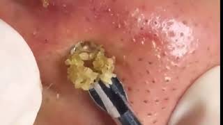 Pimple Removal Permanently  removeblackhead [upl. by Kelila]