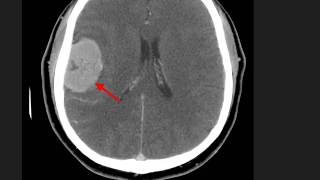 High Yield CT Scans Part 2  USMLE [upl. by Enylrac]