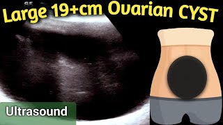 Ultrasound 19 cm Large Ovarian Cyst  equal to size of Handball in Abdomen [upl. by Yssor]