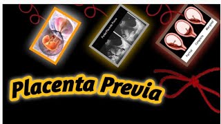 placenta previa on ultrasound placentaRadiology vibes [upl. by Dory]