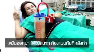 ดูดไขมันหน้าท้อง Bodytite แบนทันทีหลังทำ รัตตินันท์ เมดิคอล เซ็นเตอร์ [upl. by Cybil]