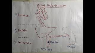 Portal hypertension [upl. by Berneta]