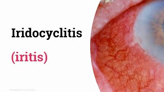 Iridocyclitis iritis [upl. by Ettenej]