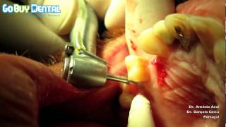 Straumann Compatible BioconceptDental Implant Surgery Step by Step V3 [upl. by Anih]