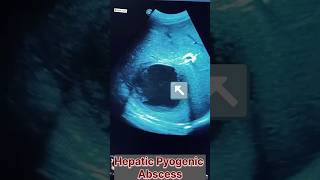 hepatic pyogenic abscess liverabscessliverbiopsy livertumor hepaticencephalopathy hepatologists [upl. by Stanway]