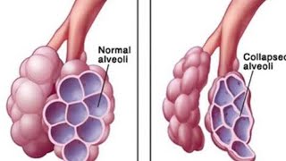 Neonatal RDSRespiratory distress syndromediyas786 [upl. by Sunda]