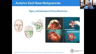 EANS WEBINARS Concept of separation surgery in spinal metastatic disease [upl. by Elsinore451]