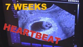 7 weeks 0 days Pregnant ULTRASOUND amp Babys HEARTBEAT ❤️ Early Pregnancy USG  AMAZING [upl. by Alexander]