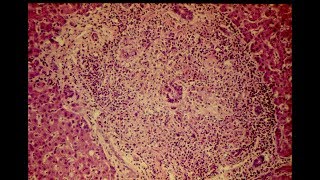 Primary Biliary Cirrhosis  Pathology mini tutorial [upl. by Hasan452]