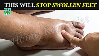 This Powerful Homemade Tea Will Cure Swollen Feet Ankles And Legs In Few Days [upl. by Lipinski]