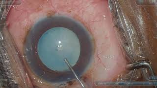 Small Canopener fb Normal Rhexis in Intumescent Cataract [upl. by Atteragram]