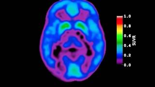 Video of AmyloidBeta Deposition in Autosomal Dominant Alzheimers Disease [upl. by Haziza]