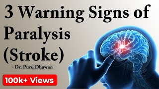 3 Warning Signs of Paralysis Stroke [upl. by Leopoldeen]