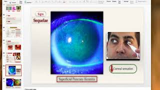 Viral keratitis [upl. by Dercy]