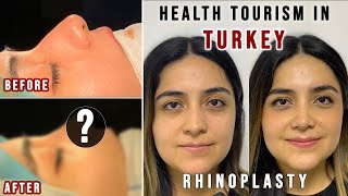 Rhinoplasty in Turkey  FULL EXPERIENCE  Affordable and Good Quality HEALTH TOURISM IN TURKEY [upl. by Noizneb618]