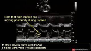 Bileaflet Prolapse of Mitral Valve on M Mode Echocardiography echocardiagram [upl. by Shaver268]