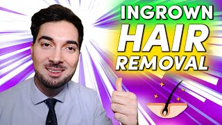 How To Get Rid Of Ingrown Hair Removal and Treatment [upl. by Bugbee870]