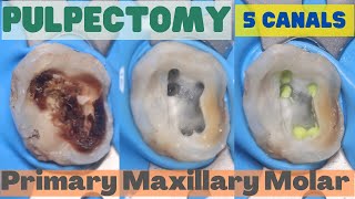 Pulpectomy ⚪️ PRIMARY MAXILLARY MOLAR 🟡 5 Canals 🔵 step by step demonstration [upl. by Atte]