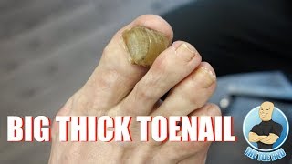 Rams Horn Toenail 2020 [upl. by Lorianna]