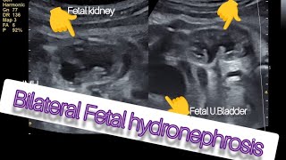 BILATERAL FETAL HYDRONEPHROSIS  BIOPHYSICAL PROFILE II PUV UPJ obstruction jonoshMedicalHub [upl. by Essyla]