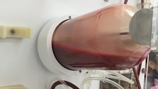 EBOO Ozone Blood Transfusion Dialysis Therapy [upl. by Cordi855]