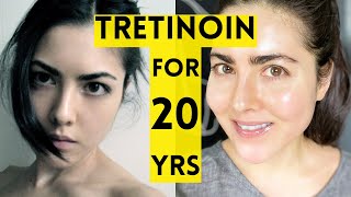 20 Year Results of Using Tretinoin [upl. by Sakiv]