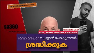 Hair Transplantation Malayalam  4 മാസത്തെ result amp updations PART 1 [upl. by Mathias]