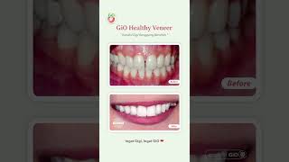 GiO Healthy Veneer [upl. by Ahseekal834]