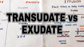 Transudate vs Exudate  Types of effusion  lights criteria [upl. by Esirec]