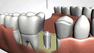 Dental Implants [upl. by Ynots]