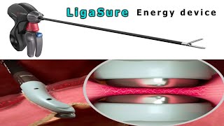 Ligasure  Bipolar energy device [upl. by Casimire7]