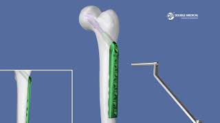 Double Medical Dynamic Hip Screw System [upl. by Ylsew258]