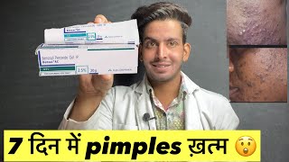 7 दिन में pimples ख़त्म 😲 Benzoyl peroxide gel 25  Benzoyl peroxide gel 25 how to use  Benzoyl [upl. by Theodoric]