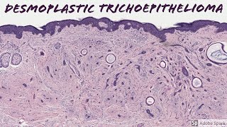 Desmoplastic Trichoepithelioma 5Minute Pathology Pearls [upl. by Dib]