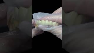 Porcelain Fused to Metal PFM Dental Bridge dentist dentallab dentalclinic smilemakeover [upl. by Atinihs153]