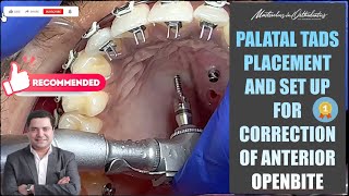 Palatal TADs Placement  Correction of Anterior Openbite  Miniscrews  MiniImplant  SAS  TAD [upl. by Shippee]