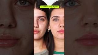 How to Treat Hormonal Acne Before amp After  eyeam 👁️ ❇️ wellness [upl. by Valeta]