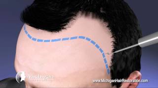 NeoGraft Michigan Hair Restoration 8444HAIRNOW [upl. by Asyle]