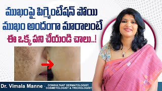 ముఖంపై నలుపు పోవాలంటే  Best Treatment for Pigmentation on Face  Dr Vimalas Skin and Laser Center [upl. by Ylicis]