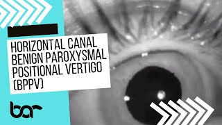 Eye Movements for Horizontal Canal BPPVTDTM episode 2 [upl. by Janessa611]