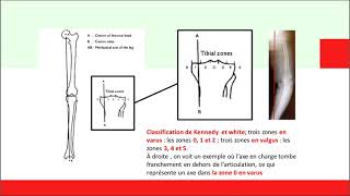 8 STEPS pour sen sortir devant une Goniométrie [upl. by Lohrman]