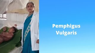 PEMPHIGUS VULGARIS Marathi pemphigus vulgaris treatment DR SMITA CHAKOTE [upl. by Leiso]