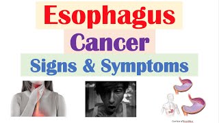 Esophageal Cancer Signs amp Symptoms amp Why They Occur [upl. by Nevuer586]