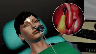 Balloon Sinus Surgery Animation [upl. by Maillil115]