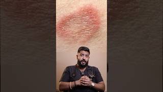 Ringworm infection drprashantharun [upl. by Mercy668]