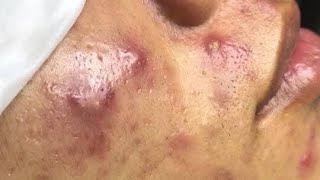 35 Blackheads amp Inflamed acne a lot  Mụn viêm và ẩn nhiều [upl. by Crandale]