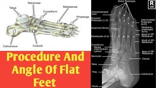 How to measure flat feet angle on Xray [upl. by Petulah]